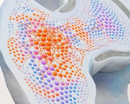 3D image of myelofibrosis in the bone.