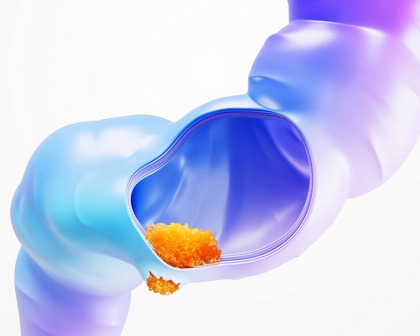 A scientific image of rectal cancer